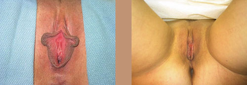 before & after vaginoplasty photo