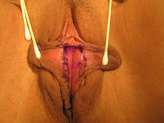 before Labiaplasty photo