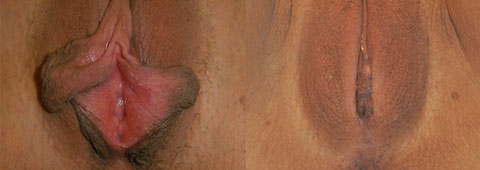 labiaplasty before and after photo