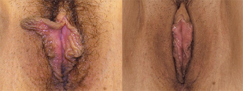 labiaplasty before and after photo